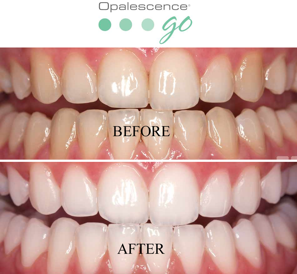 before_after